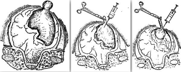 coenurosis ของการรักษาแกะ