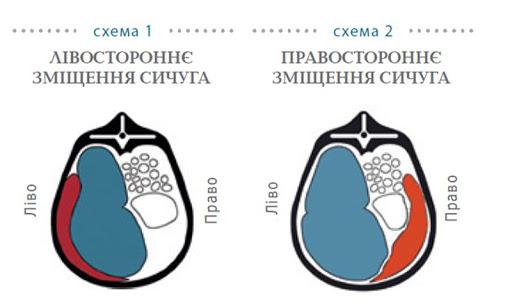 karvių abdomumo poslinkis